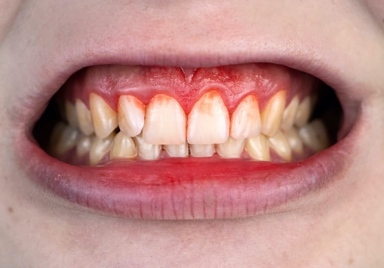 Gum bleeding