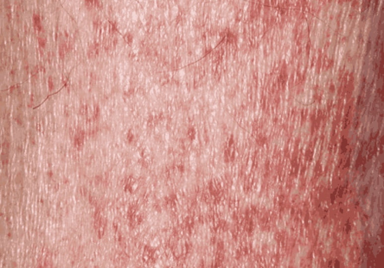 Petechial rash